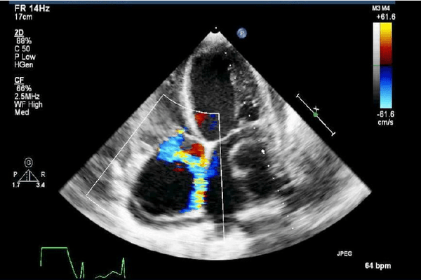 Transthoracic-colour-Doppler-echo-showing-mitral-regurgitation-and-flow-into-submitral